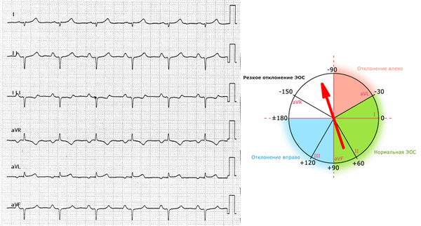 Резкое (экстремальное) отклонение ЭОС на ЭКГ.
