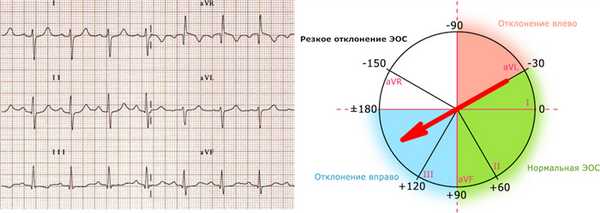 Отклонение ЭОС вправо на ЭКГ.