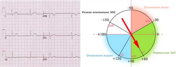 Нормальное положение ЭОС на ЭКГ.