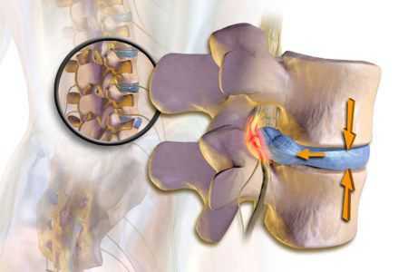 Раздражение спиномозговых корешков