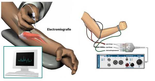Стимуляционная электромиография
