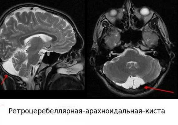 Ретроцеребеллярная киста