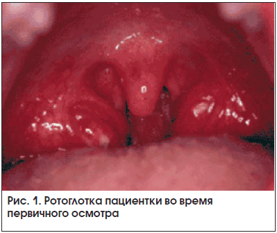 Рис. 1. Ротоглотка пациентки во время первичного осмотра