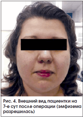 Рис. 4. Внешний вид пациентки на 7-е сут после операции (эмфизема разрешилась)