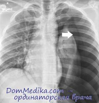 осложнения пневмоторакса