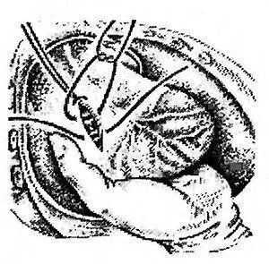 Фиксация сердца четырьмя пальцами левой руки со стороны задней стенки. Большим пальцем можно осуществлять прижатие раны для временной остановки кровотечения