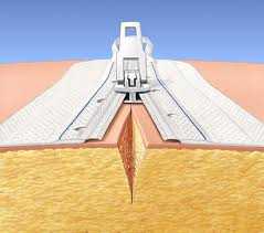 Закрытие ран