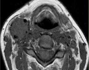 параганглиома-обр