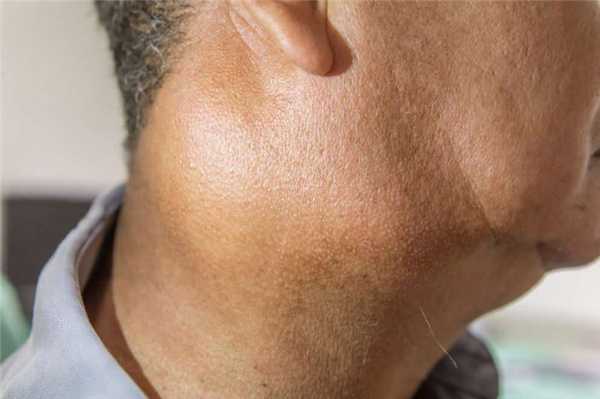 Сиалоаденит