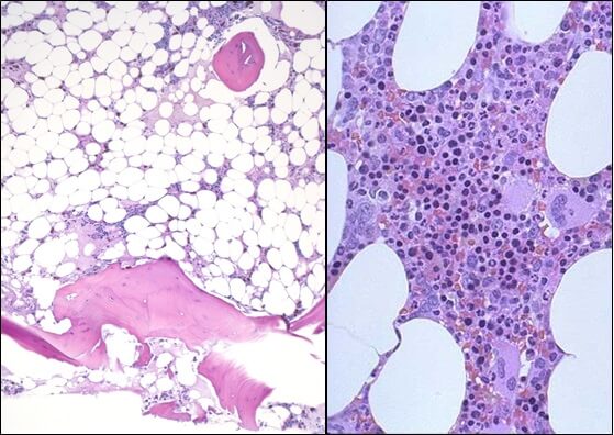 Гемолитическая анемия
