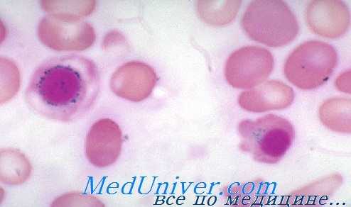 мазок при сидеробластной анемии