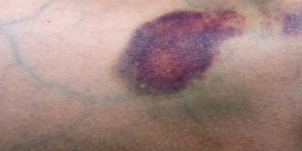 Экхимозы на коже при апластической анемии