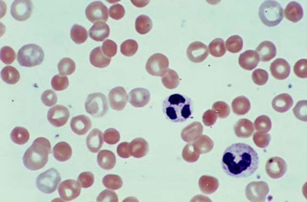 Аутоиммунная гемолитическая анемия