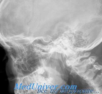 диагностика опухолей глаза