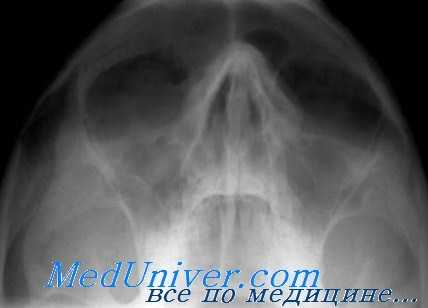 сифилис глазницы