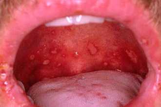 Сифилис во рту