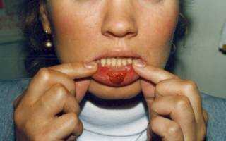 Третья стадия сифилиса во рту