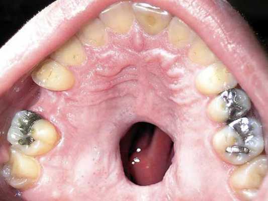 Сифилис на нёбе