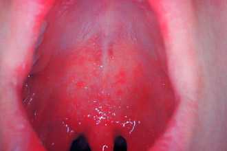 Отек слизистой при сифилисе гортани