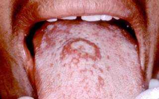 Вторая стадия сифилиса во рту