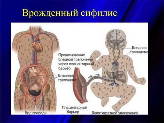 Врожденный сифилис