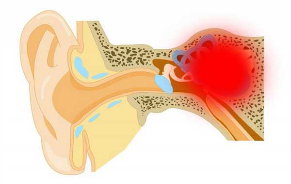 БОЛЕЗНЬ МЕНЬЕРА2.jpg