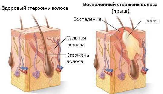 Здоровый волосяной фолликул и воспаление