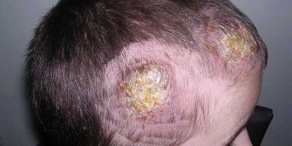 Трихофития