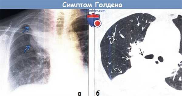 Рентгенограмма и КТ при симптоме Голдена