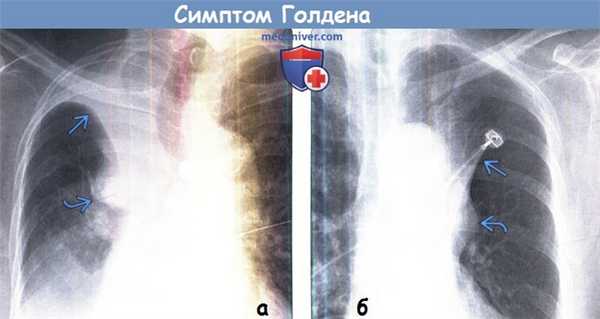 Рентгенограммы при симптоме Голдена