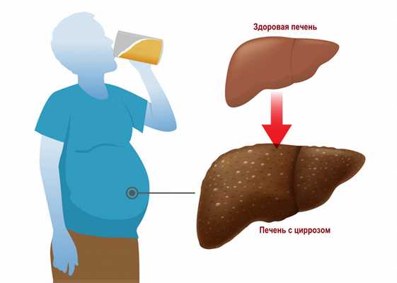 Цирроз печени.jpg