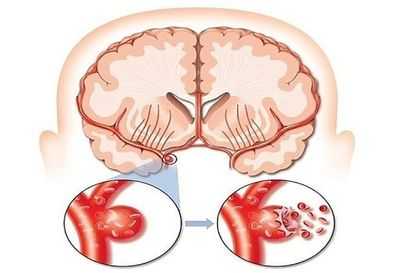 Аневризма сонной артерии