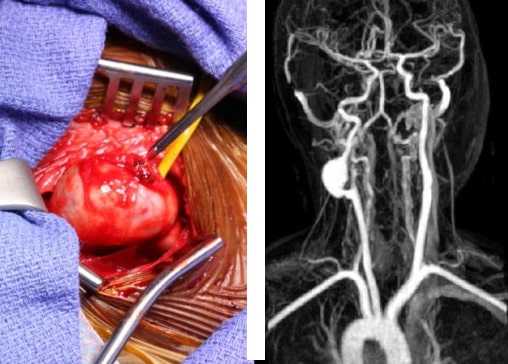 Операция при аневризме сонной артерии