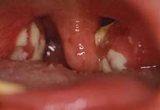 Гнойный налет