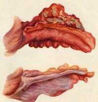 Хронический аппендицит