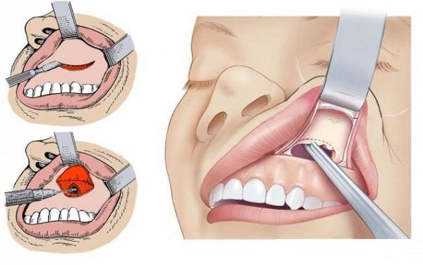Операция по Калдвелл — Люку