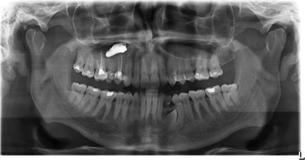 Пломбировочный материал в гайморовой пазухе [15]