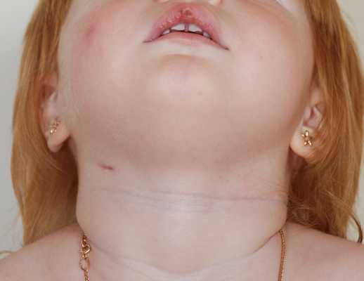 Боковой свищ шеи