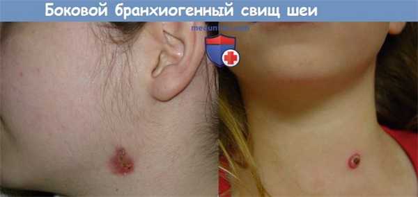 Боковой бранхиогенный свищ шеи