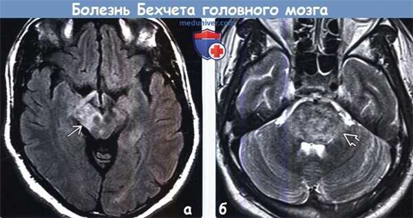 Болезнь Бехчета на МРТ головного мозга