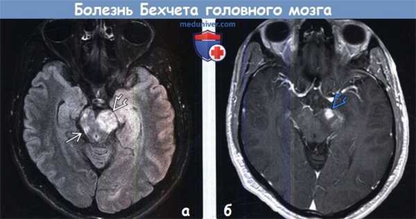 Болезнь Бехчета на МРТ головного мозга