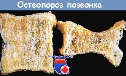 Остеопороз позвонка
