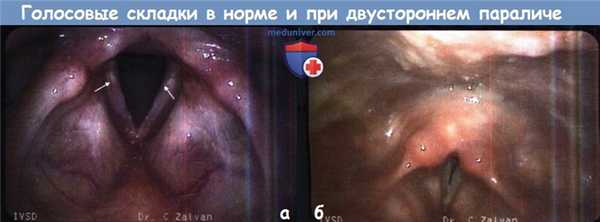 Голосовые складки в норме и при двустороннем параличе