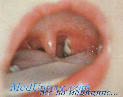 ангина при дифтерии