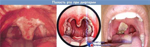 Рот при дифтерии