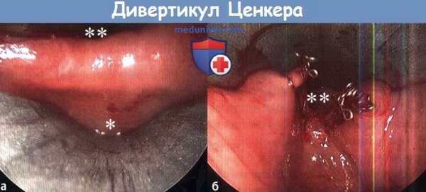 Дивертикул Ценкера