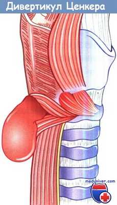Дивертикулы пищевода