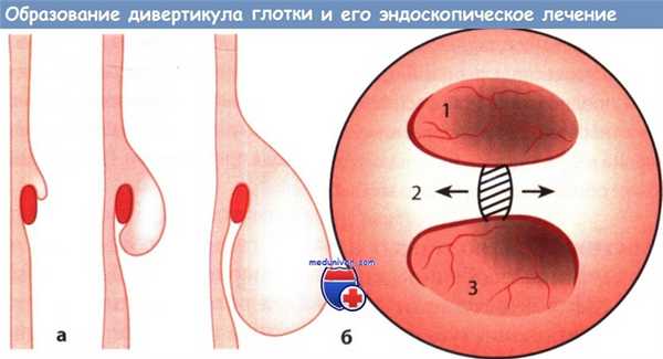 Дивертикул глотки и его эндоскопическое лечение