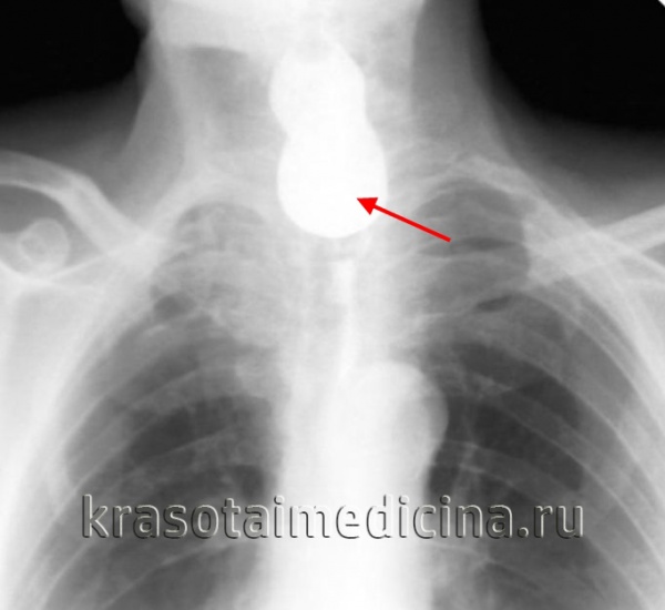 Кадр из рентгеноскопического исследования пищевода с бариевой взвесью. Дивертикул Ценкера.