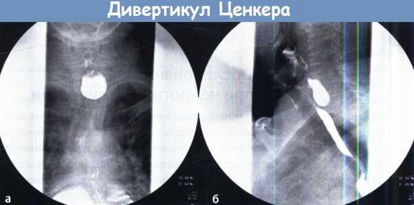 Дивертикул Ценкера